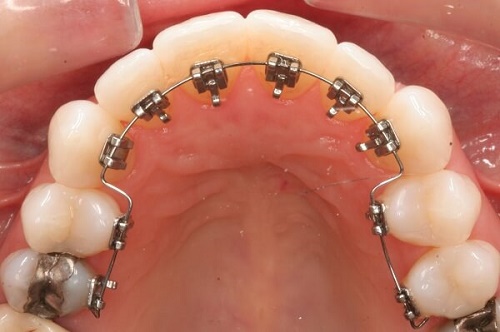 Đặc điểm của niềng răng mặt trong 2