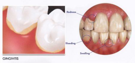 dấu hiệu và triệu chứng bệnh viêm chân răng