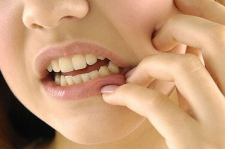 dấu hiệu và triệu chứng mọc răng khôn