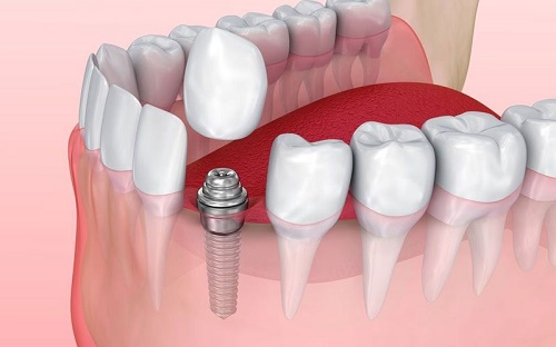 Độ bền của răng cấy ghép Implant tồn tại được bao lâu? 1