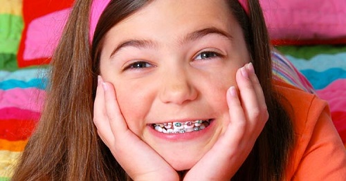 Độ tuổi thích hợp để niềng răng móm 3