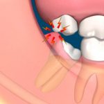 mọc răng khôn gây hôi miệng