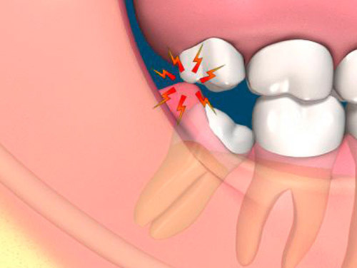 mọc răng khôn gây hôi miệng
