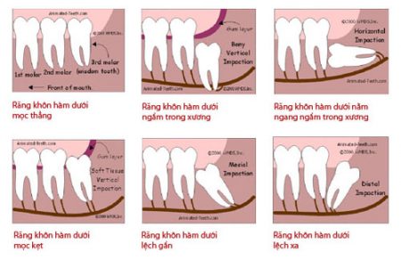 mọc răng khôn khi mang thai có sao không