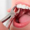 nhổ răng hàm không đau