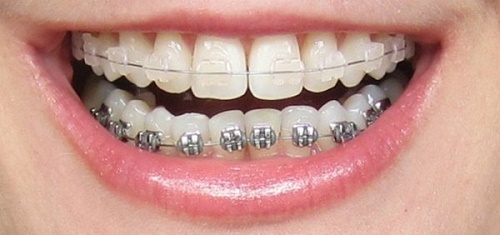 Những điều cần biết khi niềng răng cho trẻ em 2