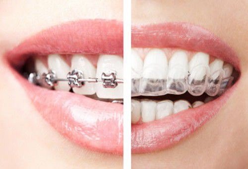 Những phương pháp niềng răng thẩm mỹ hiện nay 2
