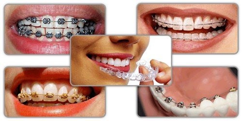 Niềng 4 răng cửa có ảnh hưởng gì không? 1