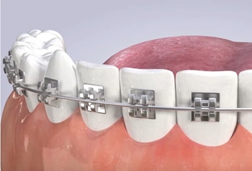 Niềng răng công nghệ 3M UGSL có ưu điểm gì? 2