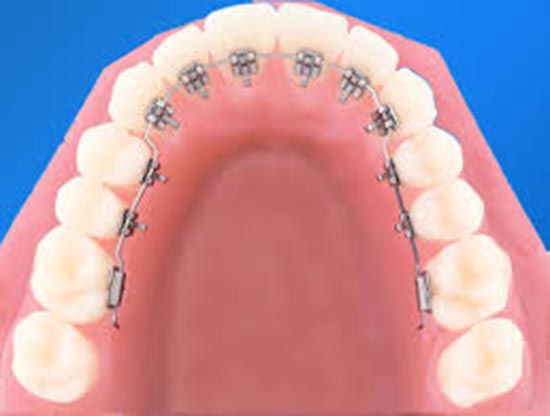 niềng răng giá rẻ nhất là bao nhiêu