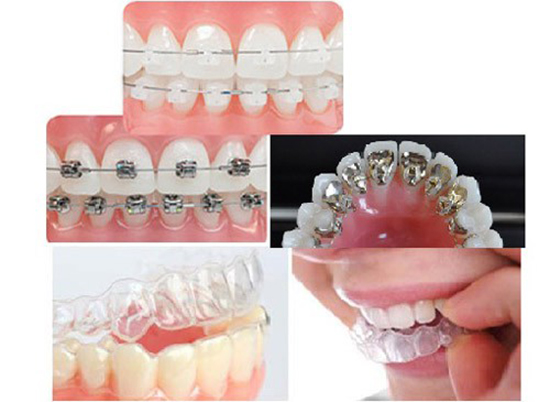 niềng răng mắc cài tự đóng