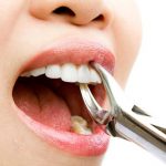 phương pháp nhổ răng khôn không đau