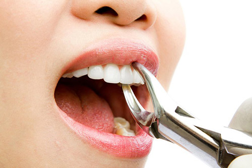 phương pháp nhổ răng khôn không đau