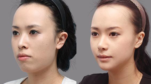 quy trình phẫu thuật chỉnh hàm hô