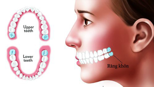 răng khôn gồm bao nhiêu cái