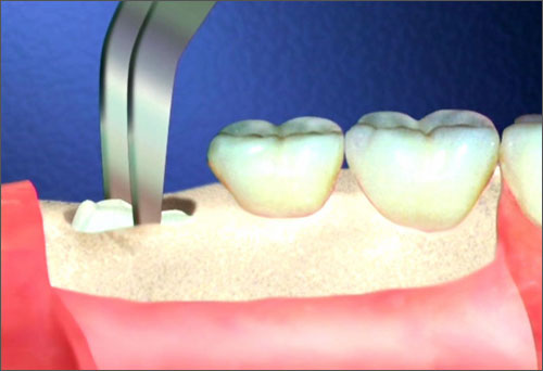 răng khôn mọc lệch ra má (