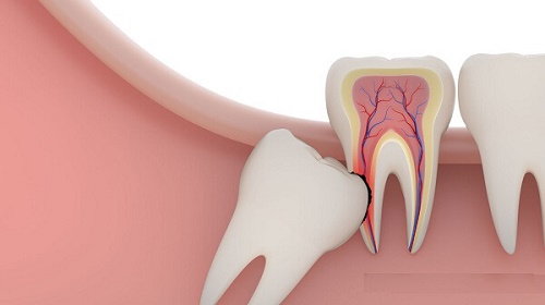 Răng khôn mọc ngầm có nên nhổ không? 2