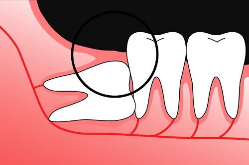 Những vấn đề thường gặp sau khi nhổ răng khôn 2
