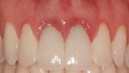 Tình trạng răng sứ bị đen viền nướu xuất hiện khi nào?