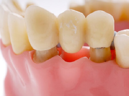 Răng sứ titan có bị đen không? Nguyên nhân do đâu