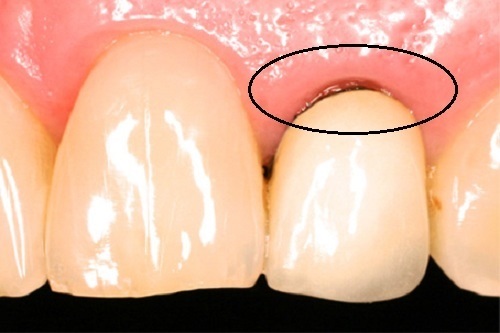 Răng sứ titan có bị đen không? Nguyên nhân do đâu