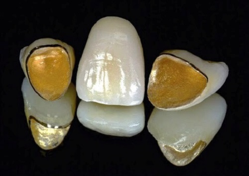 Răng sứ titan sử dụng được bao lâu? Phụ thuộc các yếu tố nào