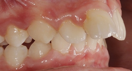 Chỉnh răng đều không cần niềng hiệu quả ra sao?