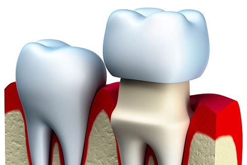 Chỉnh răng đều không cần niềng hiệu quả ra sao?