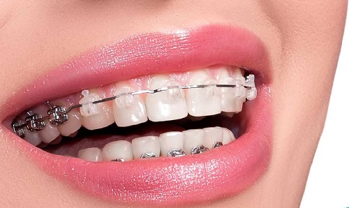 Có nên đi niềng răng không? Nên niềng răng với trường hợp nào?