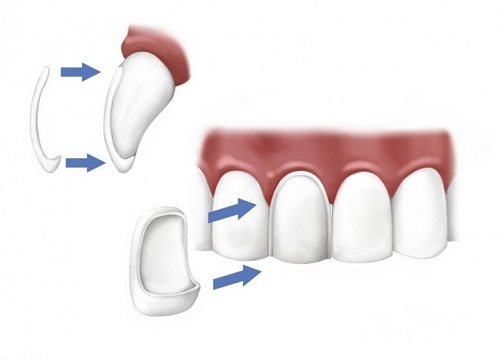 Khắc phục khuyết điểm nhờ dán răng sứ thẩm mỹ