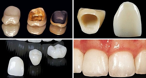 Làm răng sứ có đau không? Tìm hiểu dịch vụ răng sứ 2