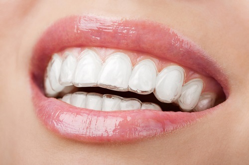 Thắc mắc: Làm răng sứ có niềng răng được không?