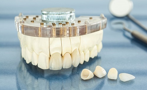 Làm răng sứ mất bao lâu -Tìm hiểu tại nha khoa