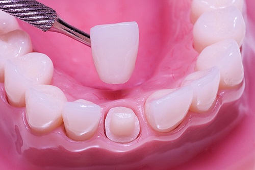 Làm răng sứ mất bao lâu -Tìm hiểu tại nha khoa
