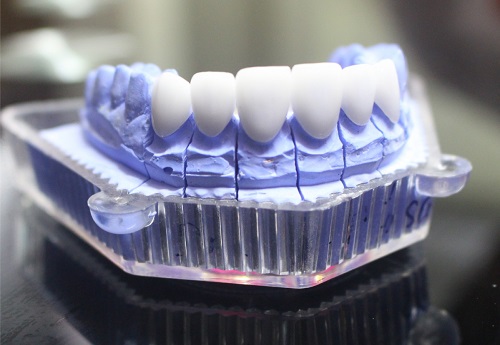 Làm răng sứ thẩm mỹ loại nào tốt? Tìm hiểu cùng chuyên gia