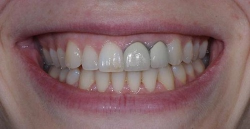 Làm răng sứ thẩm mỹ loại nào tốt? Tìm hiểu cùng chuyên gia