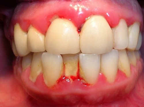 Lắp răng sứ bị sưng lợi phải làm sao?