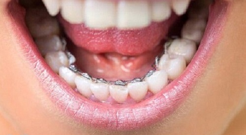Niềng răng hàm dưới bao nhiêu tiền? Gợi ý từ nha khoa