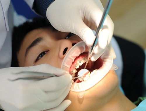 Niềng răng hàm dưới bao nhiêu tiền? Gợi ý từ nha khoa