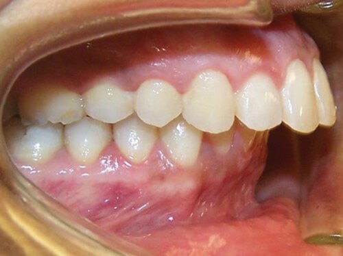 Niềng răng khớp cắn hở giải quyết tình trạng rắc rối nào?