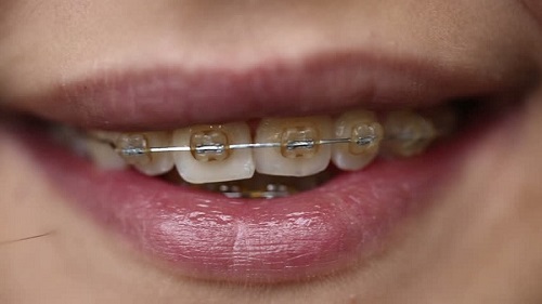 Niềng răng khớp cắn hở giải quyết tình trạng rắc rối nào?