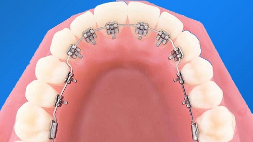Niềng răng mắc cài mặt lưỡi thẩm mỹ hiệu quả cao