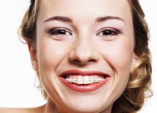 Niềng răng pha lê giá bao nhiêu tiền - Xem ngay tại đây