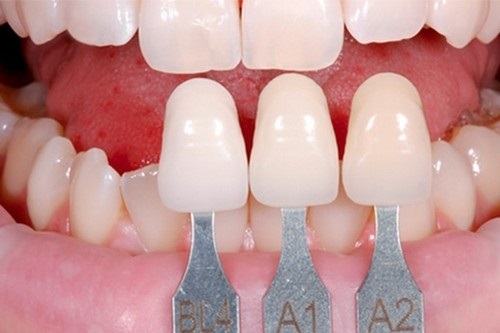 Sử dụng răng sứ có bị xuống màu không bác sĩ?