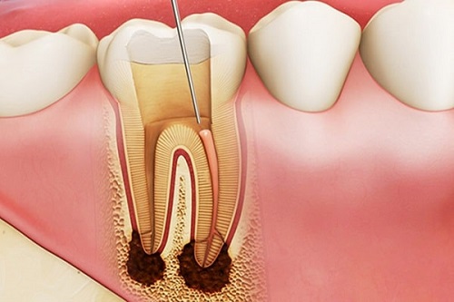Răng sứ có tháo ra được không? Khẳng định từ nha khoa