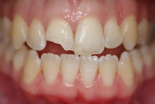 Răng sứ có trám được không khi bị mẻ vỡ?