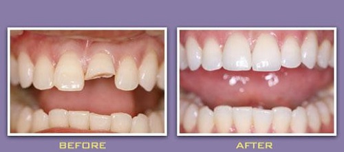 Răng sứ có trám được không khi bị mẻ vỡ?