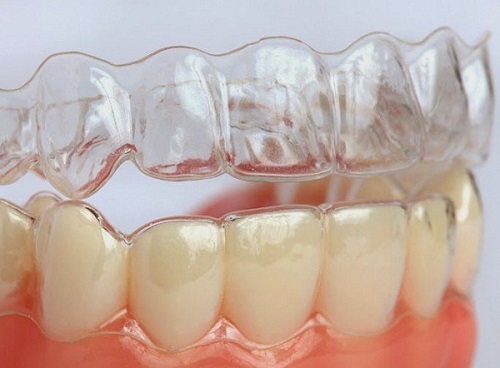Chữa răng hô không cần niềng có thực sự hiệu quả?