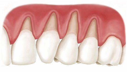 Niềng răng bị lòi chân răng có nguy hiểm không? Cách xử lý
