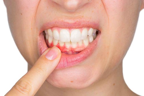 Niềng răng bị lòi chân răng có nguy hiểm không? Cách xử lý
